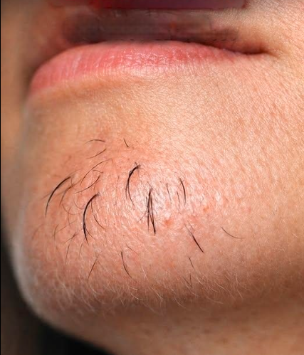 Why Do Women Get Chin Hair? Causes Explain