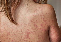 What Causes a Widespread Back Rash? Signs, Symptoms, and When to Seek Help