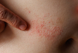 Itchy Rash Under the Breasts? Possible Causes and What You Can Do